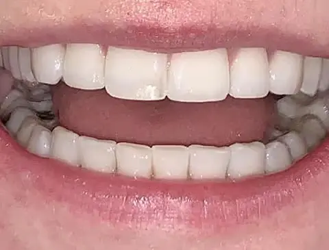 center-teeth-apart