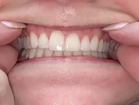 center-teeth-together