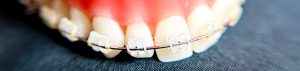 Braces for adults in Durham & Oxford, NC - Wilson Orthodontics