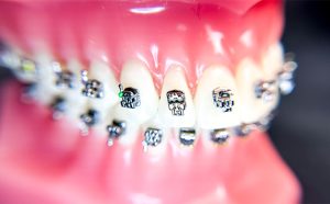 Early orthodontics in Durham & Oxford, NC - Wilson Orthodontics 4