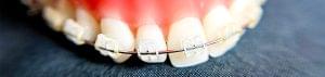 Braces for adults in Durham & Oxford, NC - Wilson Orthodontics