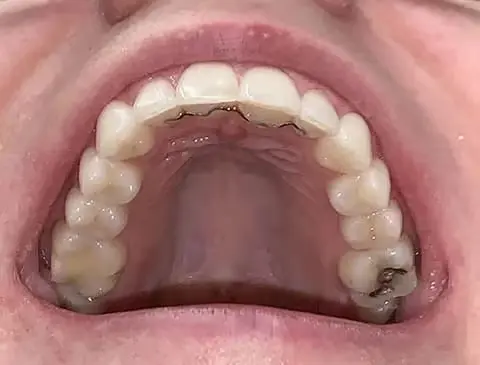 upper-arch